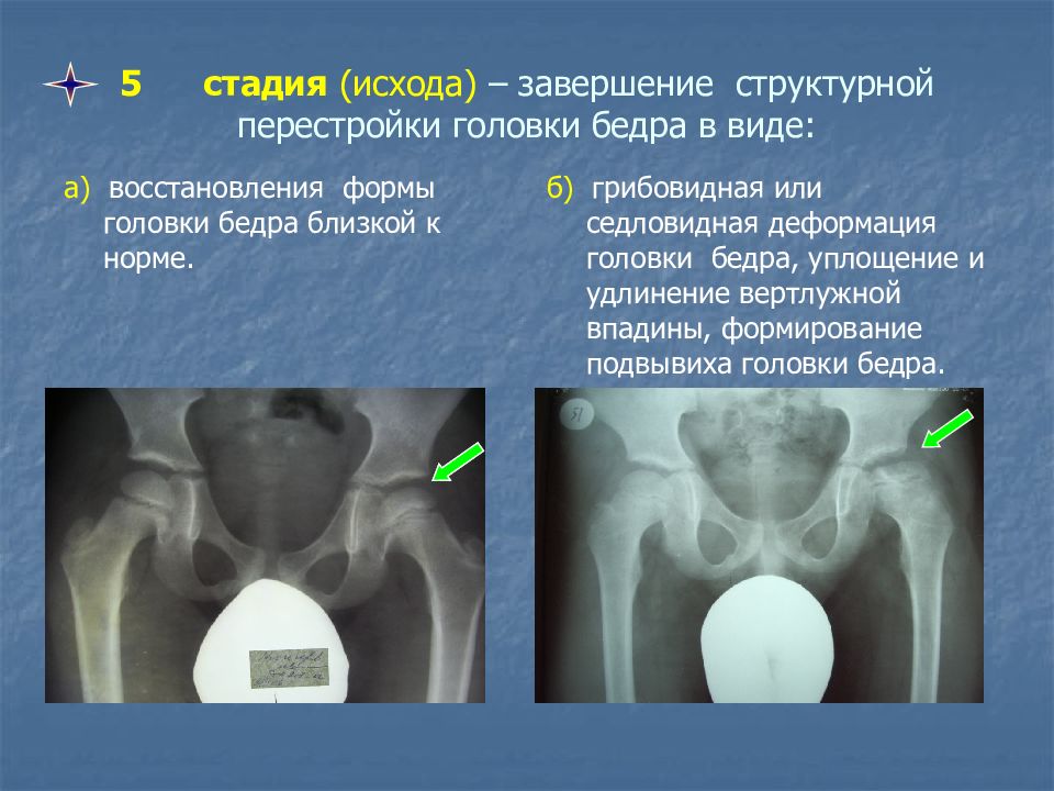 Презентация болезнь пертеса