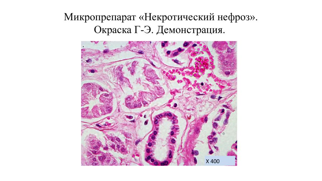 Нефроз