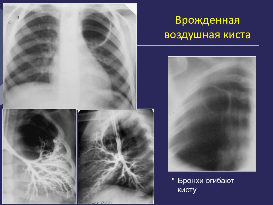 Кисты легких у детей презентация