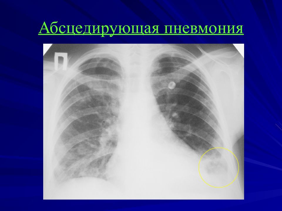 Диагностика легких. Абсцедирующая пневмония рентген. Абсцедирующая (очаговая, септическая) пневмония. Абсцесс легкого пневмония рентген. Пневмония рентген лучевая диагностика.