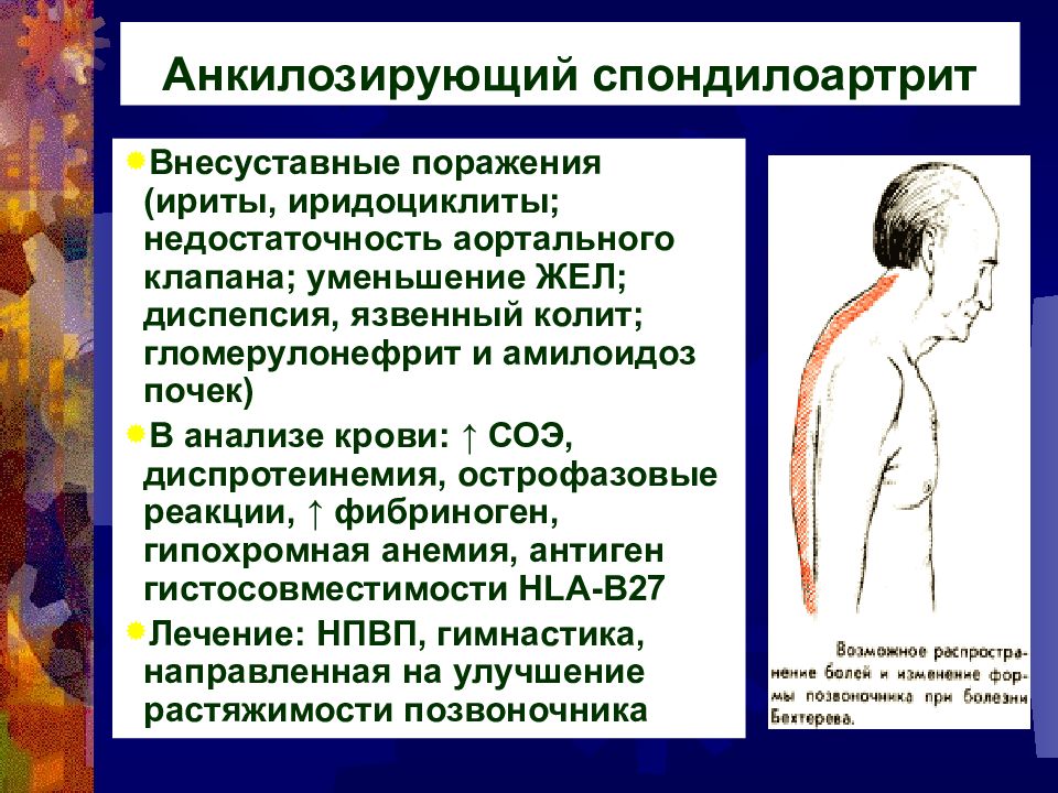 Анкилозирующий спондилоартрит. Диф диагноз анкилозирующего спондилоартрита. Анкилозирующий спондилоартрит диагноз. Анкилозирующий спондилоартрит внесуставные проявления. Анкилозирующий спондилит симптомы.