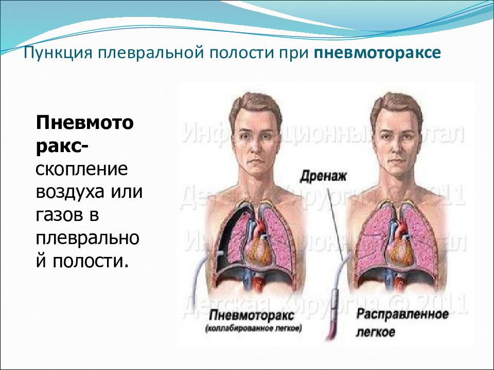 Гидроторакс карта вызова скорой медицинской помощи