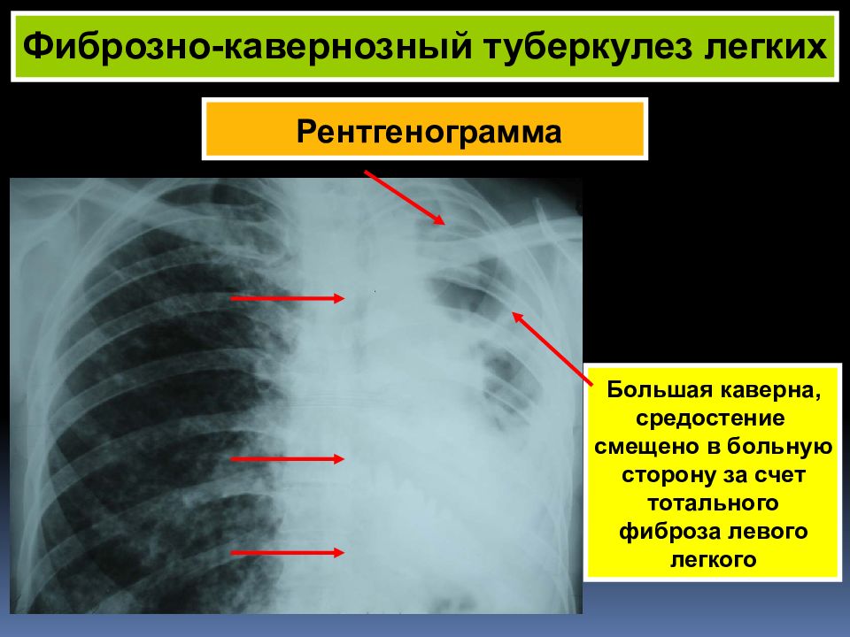 Фиброзно изменен легочный рисунок что это значит