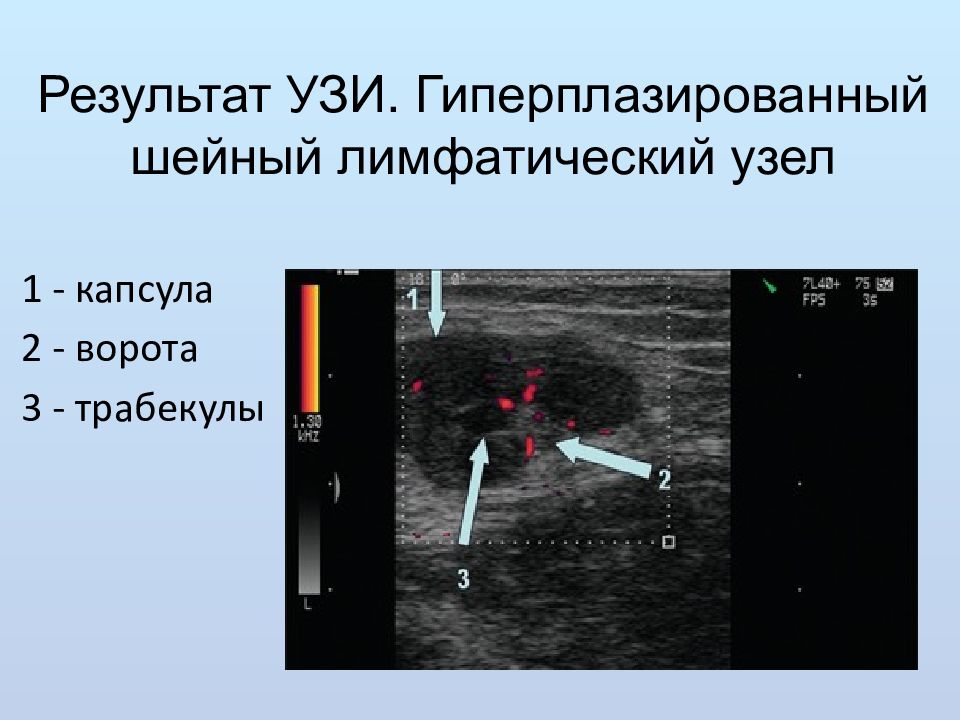 Узи лимфатических. УЗИ лимфатических узлов. УЗИ лимфатических узлов шеи. УЗИ поверхностных лимфатических узлов .. Патологические лимфоузлы на УЗИ.