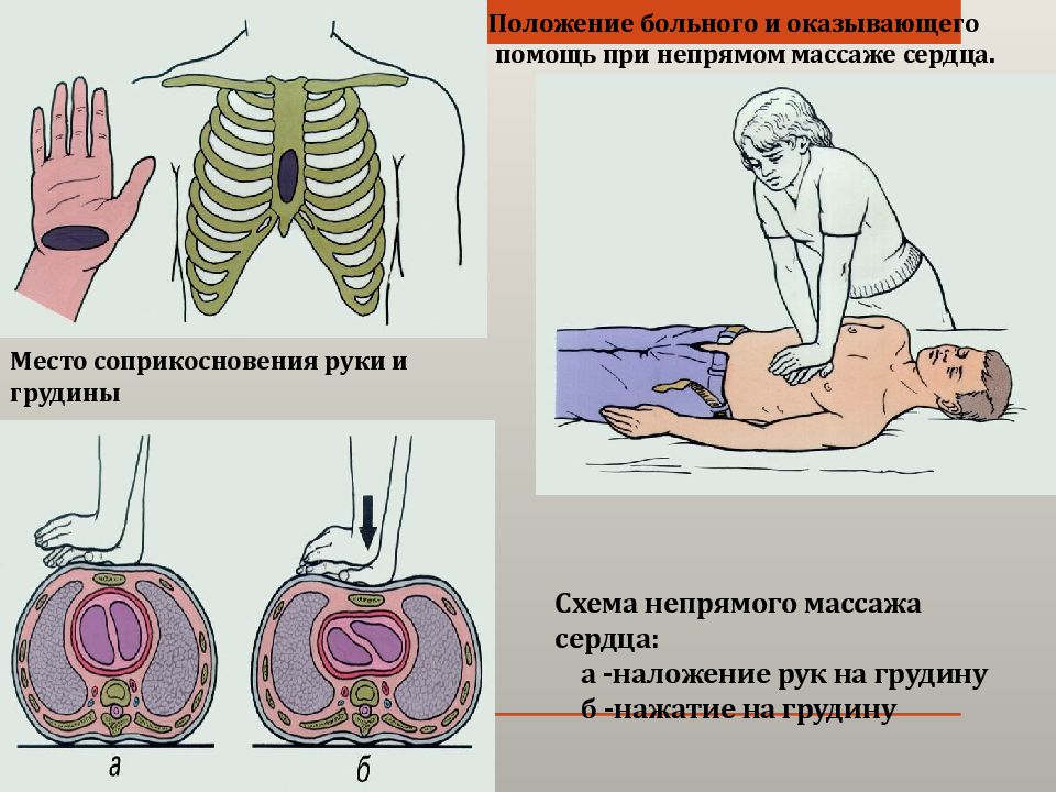 Непрямой массаж сердца рисунок