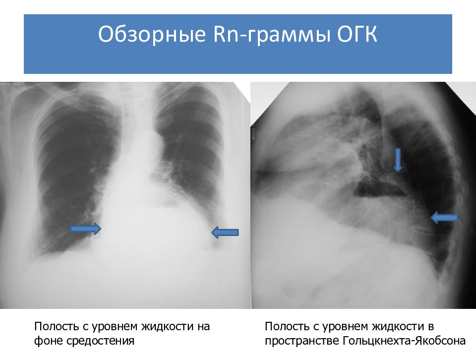 Огк это. Диафрагмальная грыжа рентген ОГК. Диафрагмальная грыжа пищевода рентген. Грыжа диафрагмы рентген. Грыжа средостения рентген.