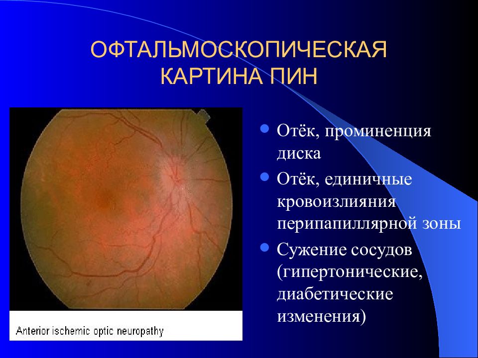 Заболевания зрительного нерва презентация