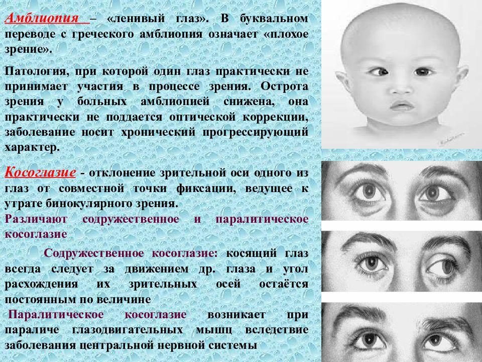 Синдром вялого ребенка. Амблиопия ленивый глаз. Нарушение зрения косоглазие. Косоглазие и амблиопия.