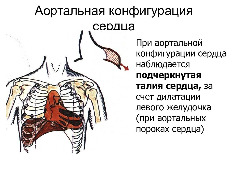 Перкуссия сердца презентация