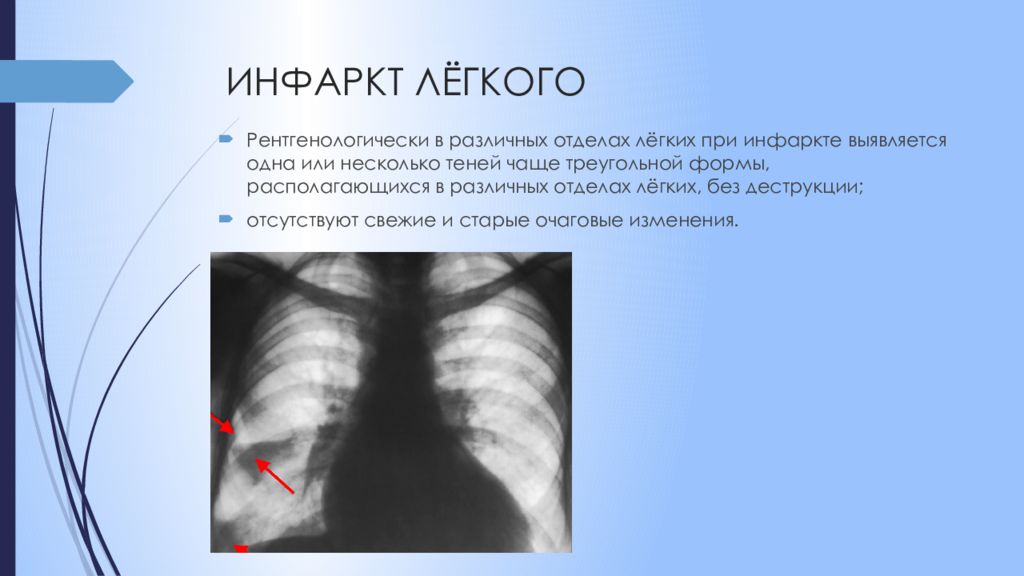 Инфаркт легкого. Клиническая картина инфаркта легкого. Причины инфаркта легкого. Инфаркт легкого диагностика.