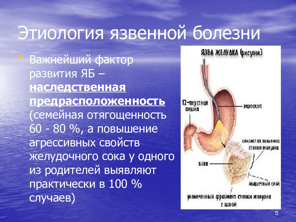 Язвенной болезни желудка презентация