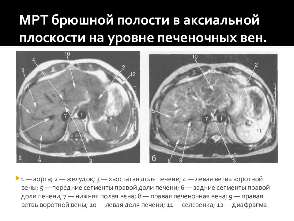 Сегменты печени мрт схема