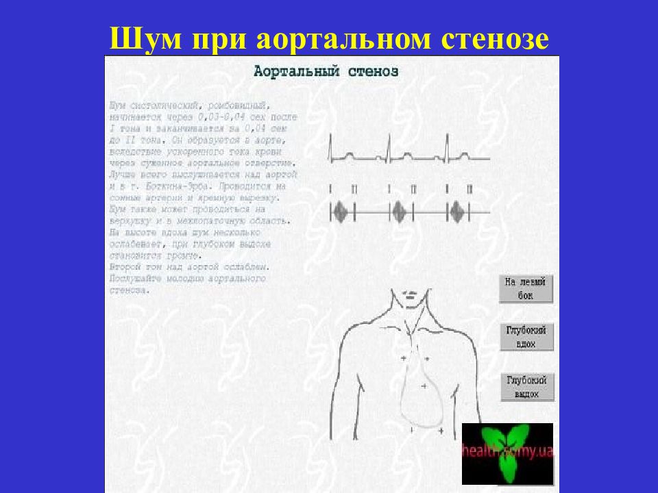 Аускультативная картина аортальной недостаточности тест