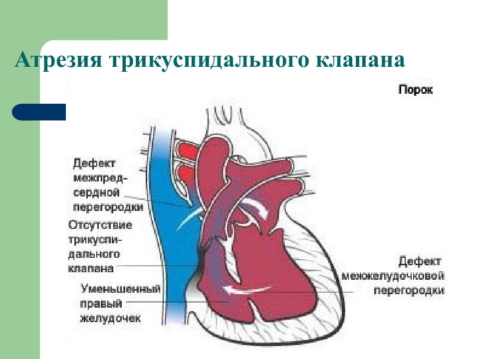 Трикуспидальный клапан. Атрезия трехстворчатого клапана. Атрезия двустворчатого клапана. Порок сердца атрезия трехстворчатого клапана. Атрезия 3 створчатого клапана.