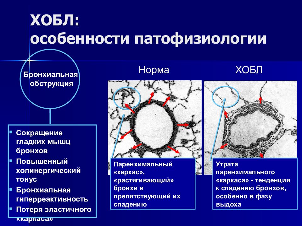 Патофизиология хобл презентация