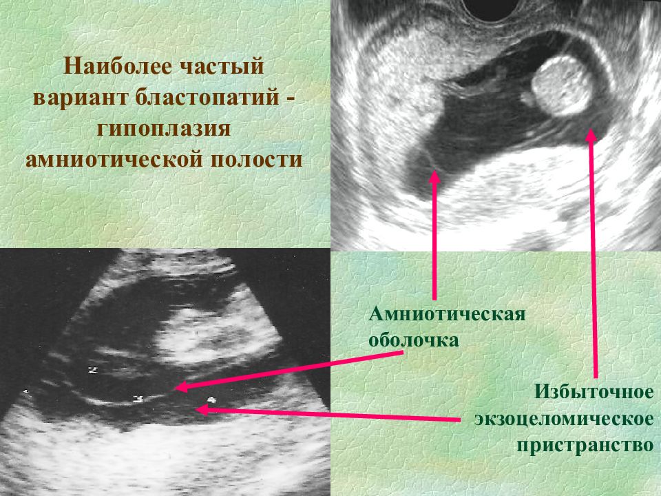 Гипоплазия эндометрия форум. Хориальная полость на УЗИ. Гипоплазия амниотической полости. Амниотическая перетяжка на УЗИ.