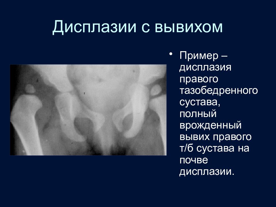 Врожденный вывих бедра презентация травматология