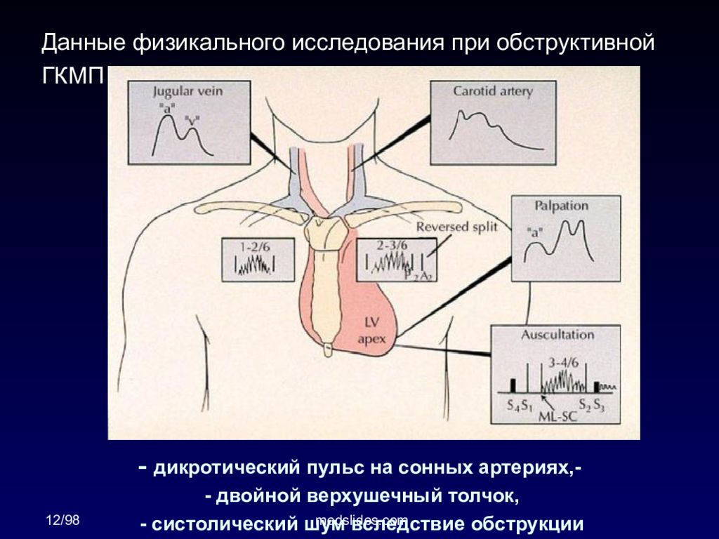 Шум на сонных артериях