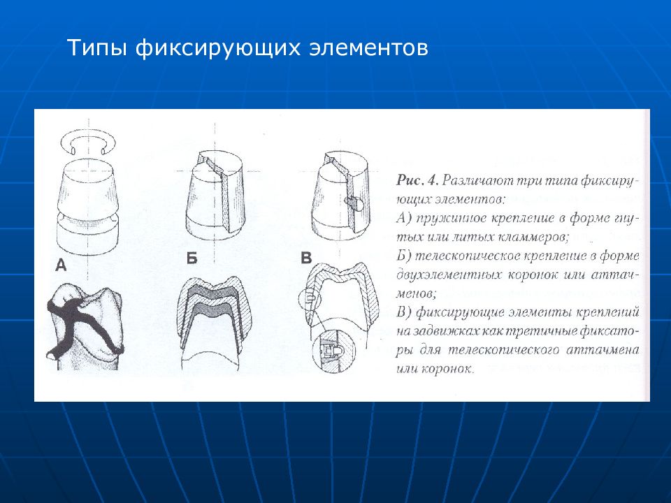 Виды фиксации. Фиксирующий элемент. Фиксирующие элементы типы. Тип закрепления зафиксировать.