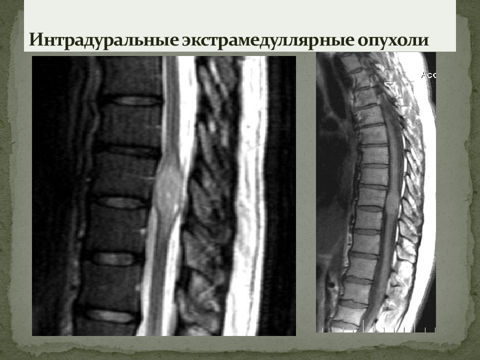 Опухоли спинного мозга презентация