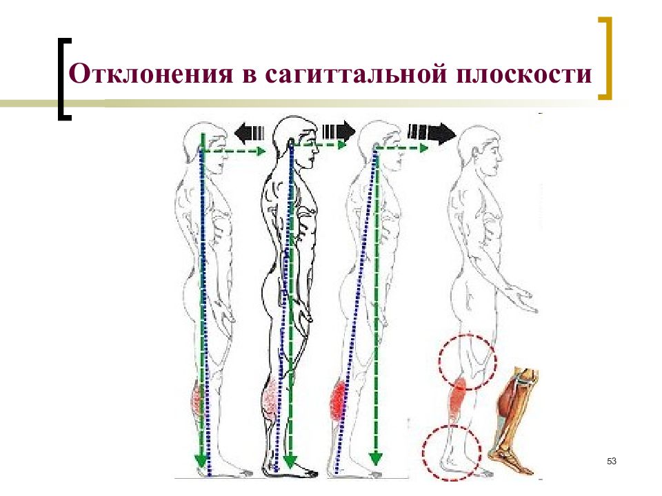 Сагиттальная плоскость. Сагиттальная плоскость позвоночника. Отклонение в сагиттальной плоскости. Отклонения в сагиттальной плоскости позвоночника.