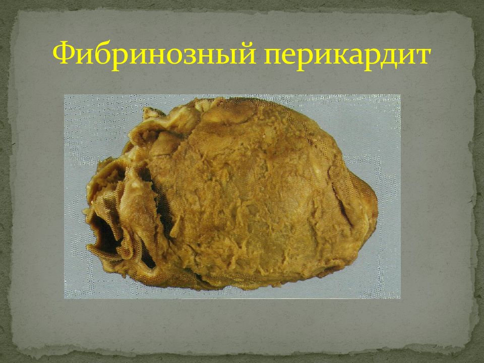 Fibrinous Pericarditis - Histopathology - YouTube