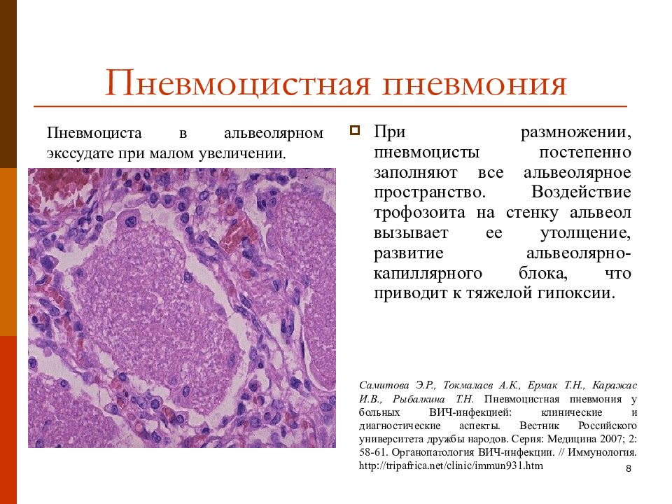 Пневмония микропрепарат описание. Цитомегаловирусная пневмония патанатомия. Пневмоциста гистология. Пневмоцистная пневмония при ВИЧ инфекции патанатомия. Патологическая анатомия пневмоцистной пневмонии.