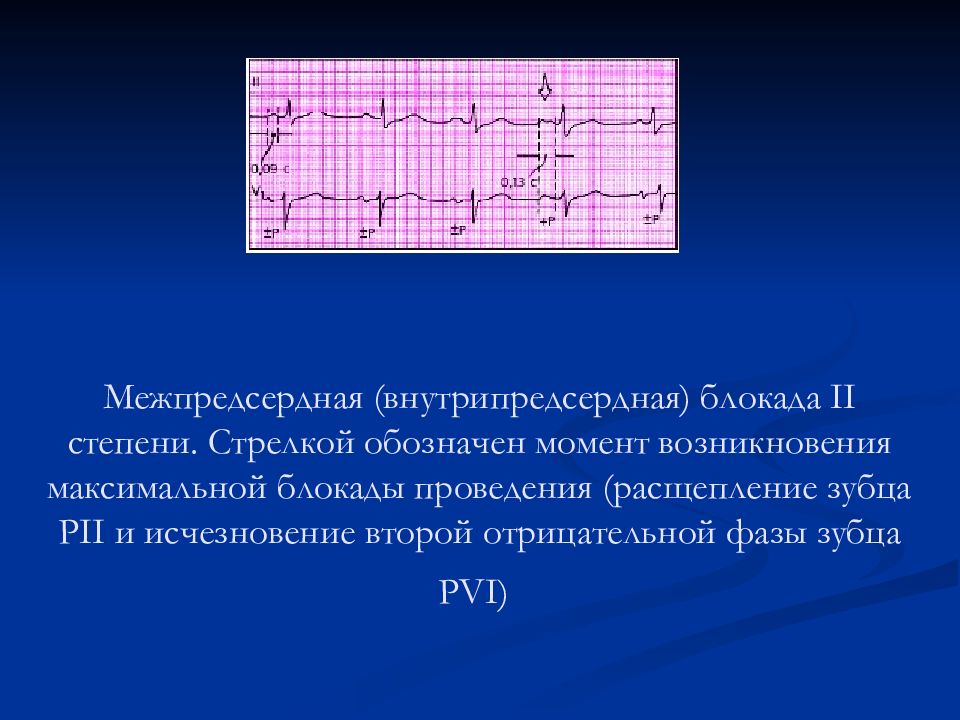 Внутрипредсердная проводимость. Внутрипредсердная блокада на ЭКГ. ЭКГ внутрипредсердная блокада av блокада 2 степени. Внутрипредсердная блокада 1 степени на ЭКГ что это такое. Внутрипредсердная блокада 2 степени на ЭКГ.