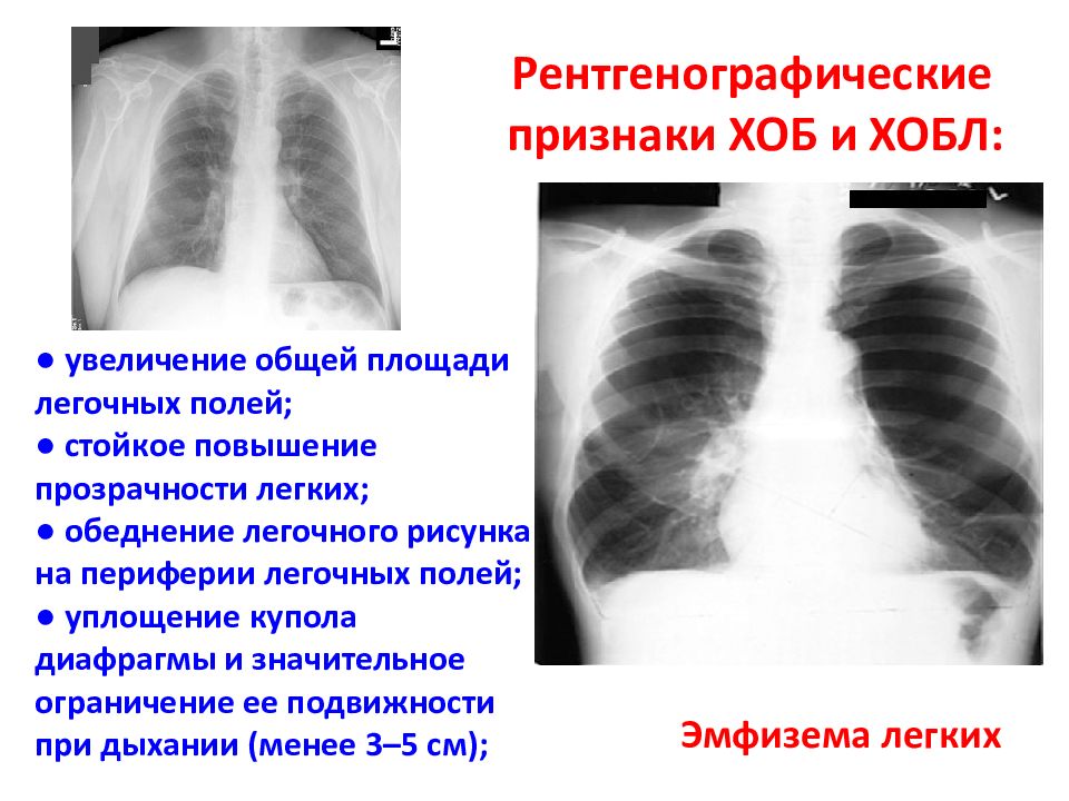 Поле легкого. Рентген признаки ХОБЛ. ХОБЛ рентгенологические признаки. Повышение прозрачности легочных полей. Прозрачность легочных полей повышена.