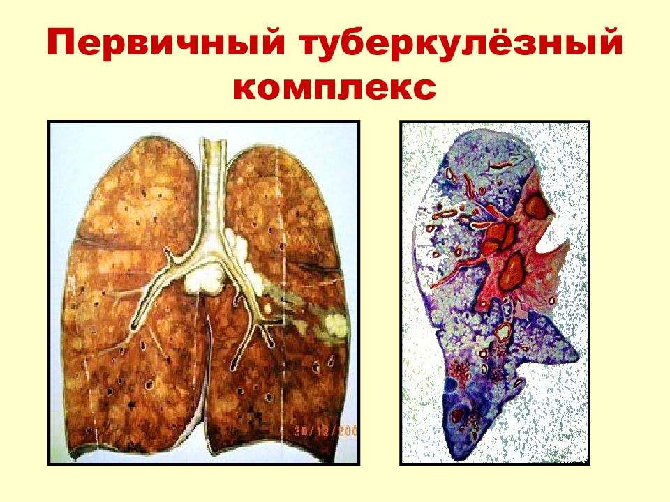 Первичный туберкулез картинки