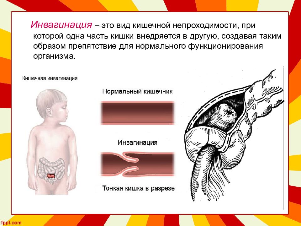 Приобретенная кишечная непроходимость у детей презентация