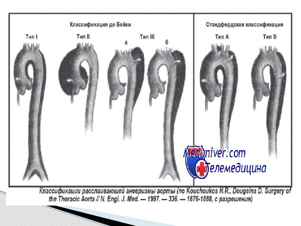 Аневризмов аорты. Расслаивающая аневризма по Дебейки. Типы аневризм аорты по Дебейки. Аневризма аорты 1 Тип по Дебейки. Классификация расслоения аорты по Дебейки.