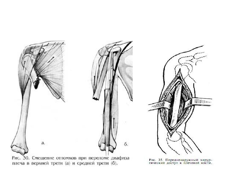 Переломы плечевой кости презентация