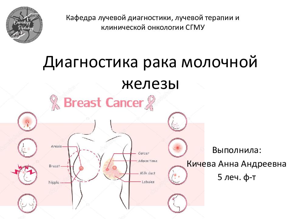 Как выглядит рак молочной железы у женщин