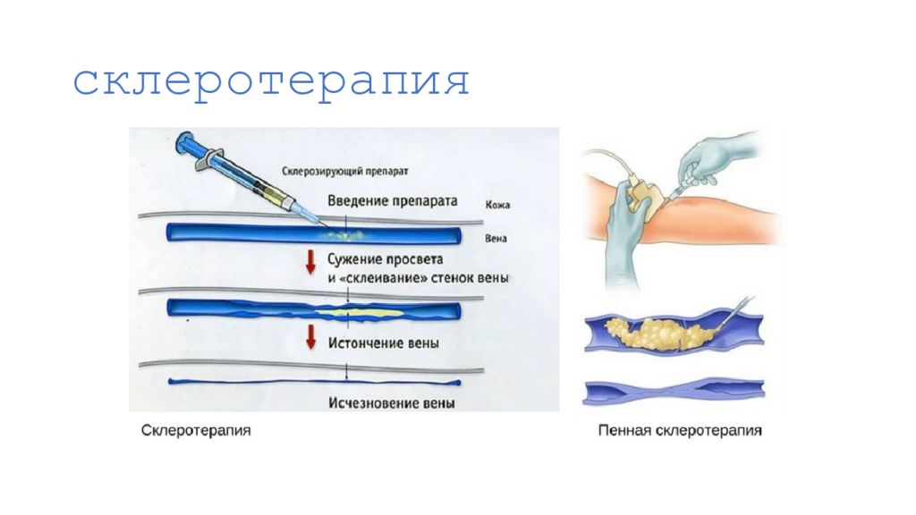 Склеротерапия вен конечностей. Склеротерапия варикозной болезни. Склеротерапия последствия. Последствия склерозирования.