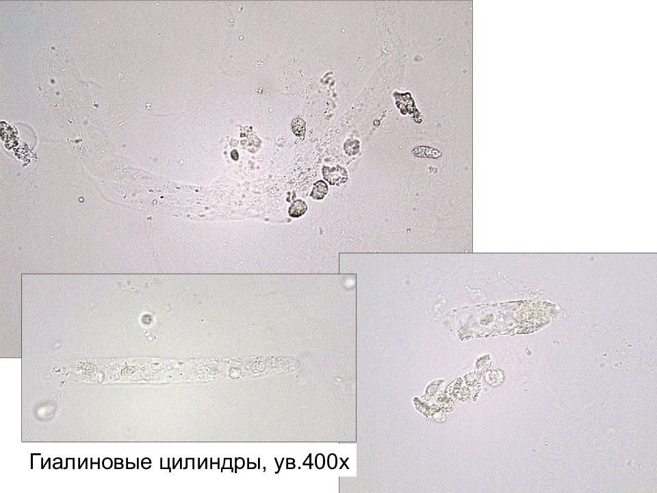 Цилиндры в моче фото под микроскопом