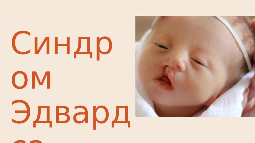 Синдром Эдвардса