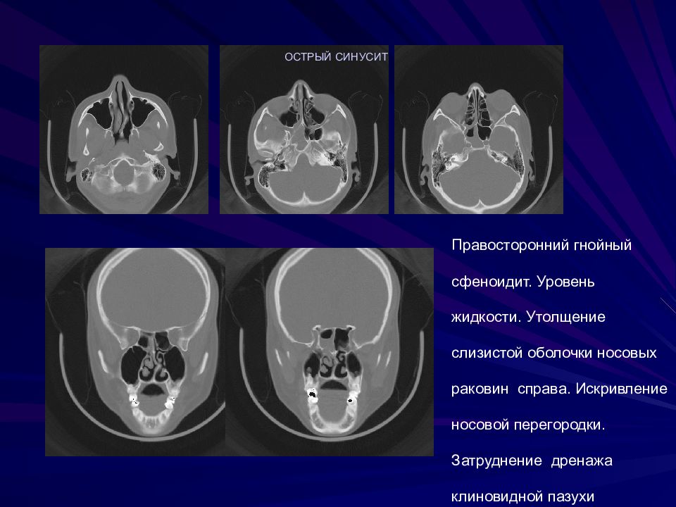 Кт синусов. Клиновидная пазуха на кт. Компьютерная томография придаточных пазух носа. Кт анатомия придаточных пазух.
