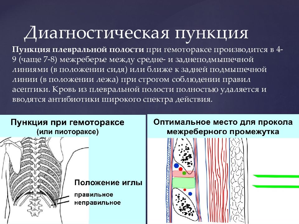 Пункция полостей. Диагностическая пункция плевральной полости. Диагностическая значимость плевральной пункции. Пункция плевральной полости при гидротораксе техника. Плевральная пункция при гемотораксе проводится.