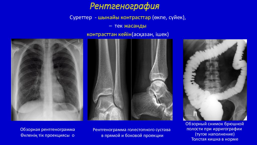 Флюорография и рентген отличия. Контрастность рентгеновского снимка. Рентгеноскопия и рентгенография. Рентгенография от рентгеноскопии. Рентгенография рентгеноскопия флюорография.