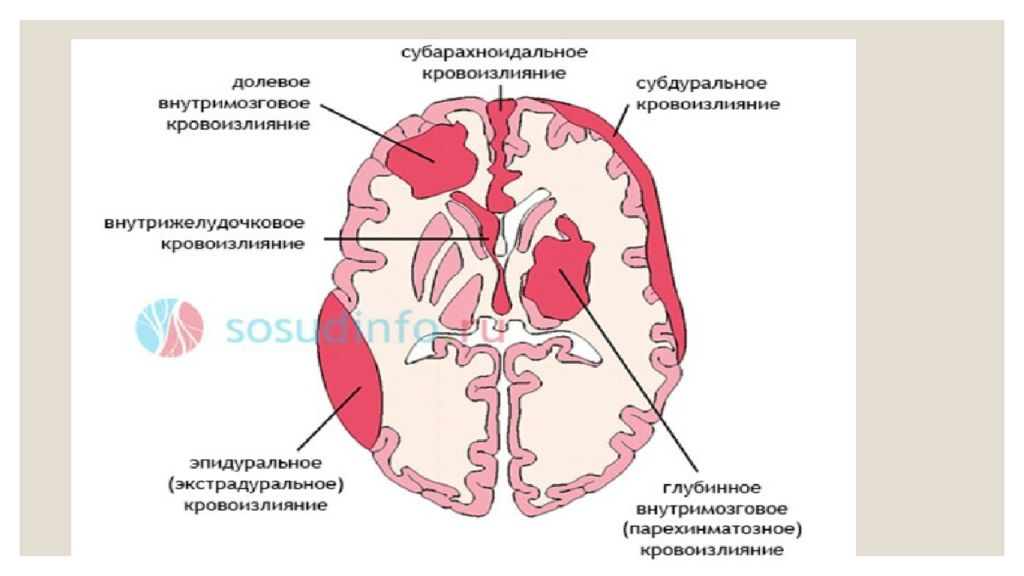 Кровоизлияние головного мозга новорожденного