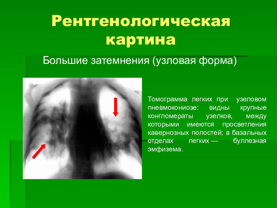 Пневмокониоз. Пневмокониоз : бериллиоз. Рентгенодиагностика пневмокониозов. Пневмокониоз рентген признаки. Узелковая форма пневмокониоза.