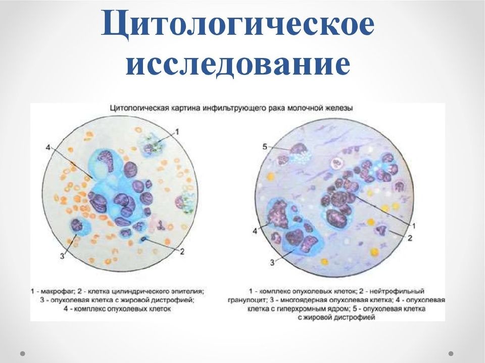 Цитологическая диагностика заболеваний молочной железы презентация