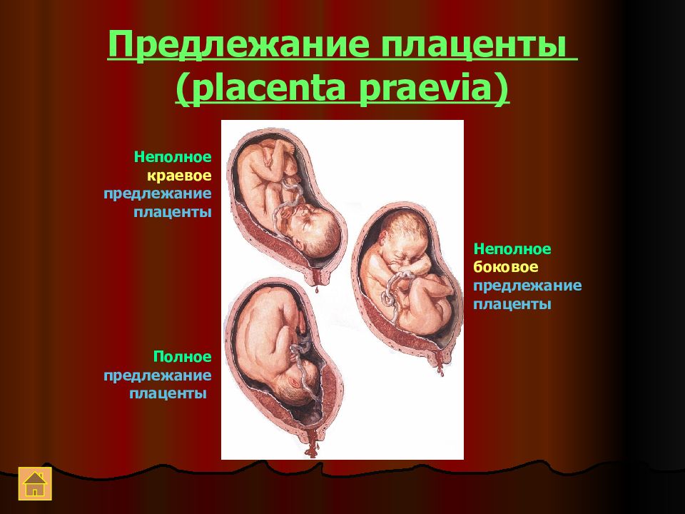 Предлежание плаценты картинки