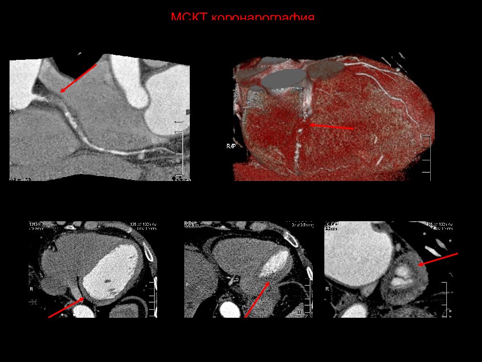 Атеросклероз мрт. Кт коронарография сосудов. Кт-ангиография коронарных артерий. Мультиспиральная кт коронарных артерий. Мультиспиральная кт сердца.