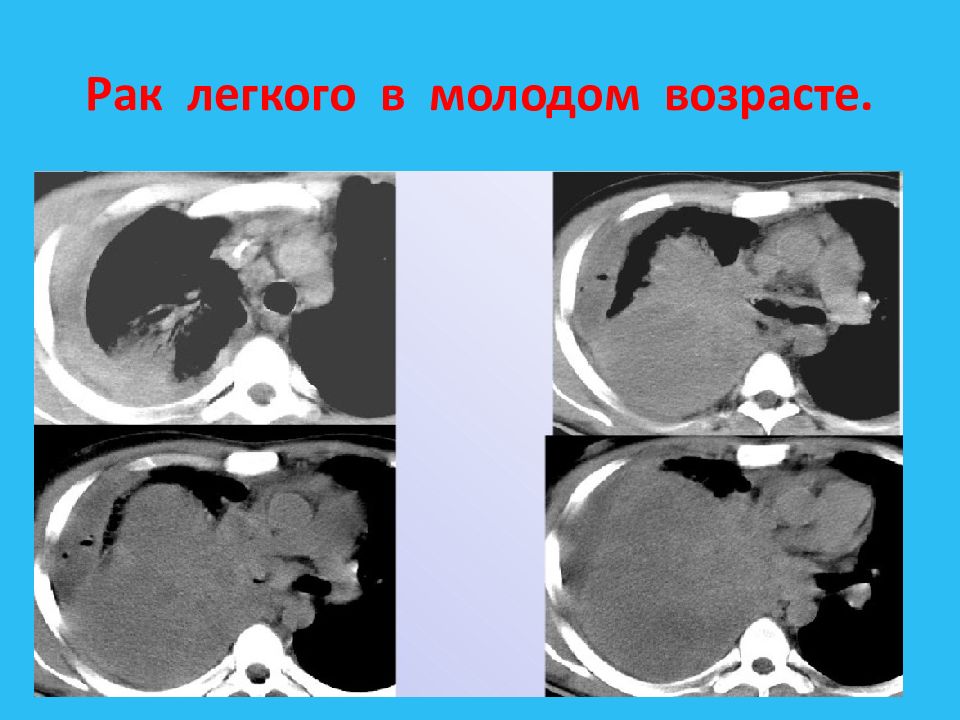 Центральный рак легкого презентация