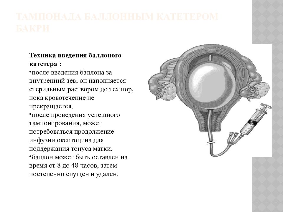 Послеродовое кровотечение презентация