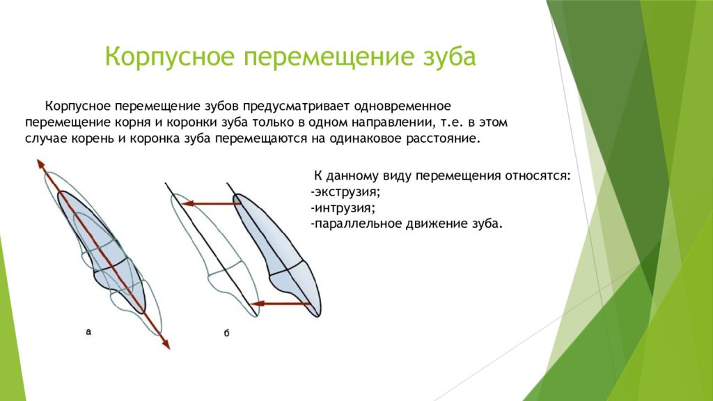 Тип перемещения. Корпусное перемещение зубов в ортодонтии. Виды перемещения зубов при ортодонтическом лечении. Виды перемещения зубов биомеханика перемещения зубов. Корпусное перемещение зуба.