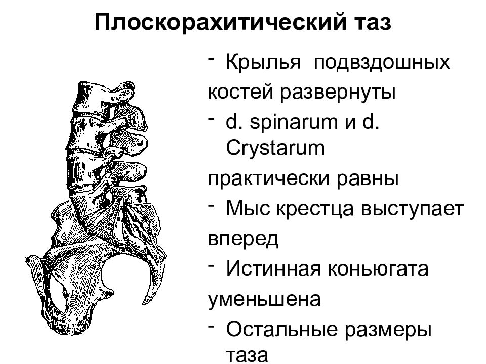 Анатомически и клинически узкий таз презентация