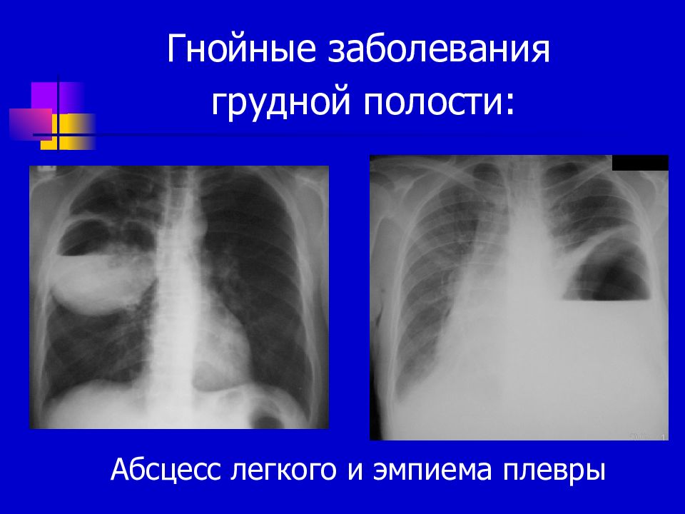 Абсцесс легкого презентация хирургия